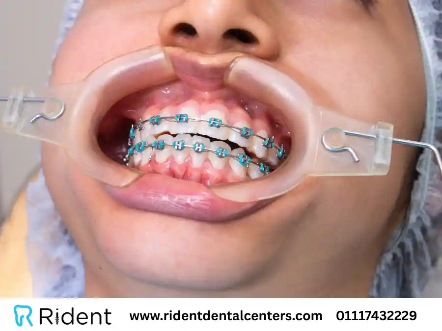 سعر تقويم الأسنان اليوم 2025 في مصر